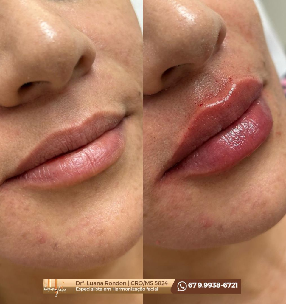 Harmoface - Clínica de Estética - Harmonização Facial e Botox — Jardim Monte Libano, Campo Grande